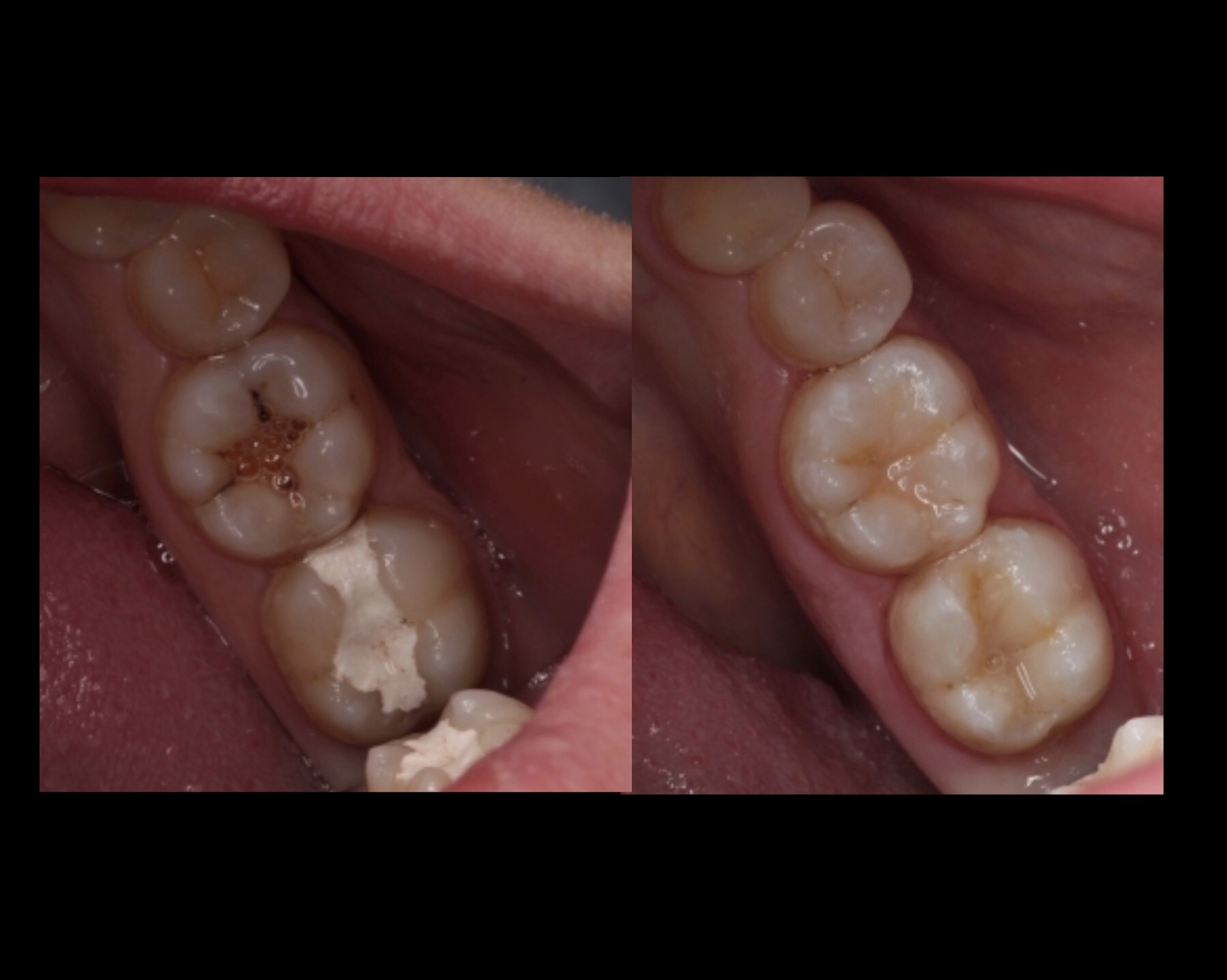 composite bonding